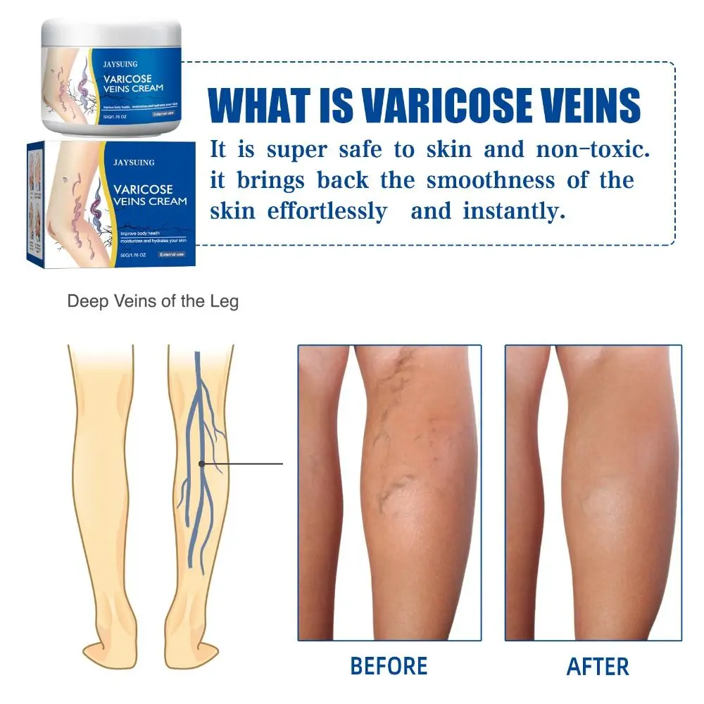 50g/1.76fl.oz Legs Varicose Veins Treatment Pain Relief Mild & Safe Legs Skin Cream Moisturizes The Skin