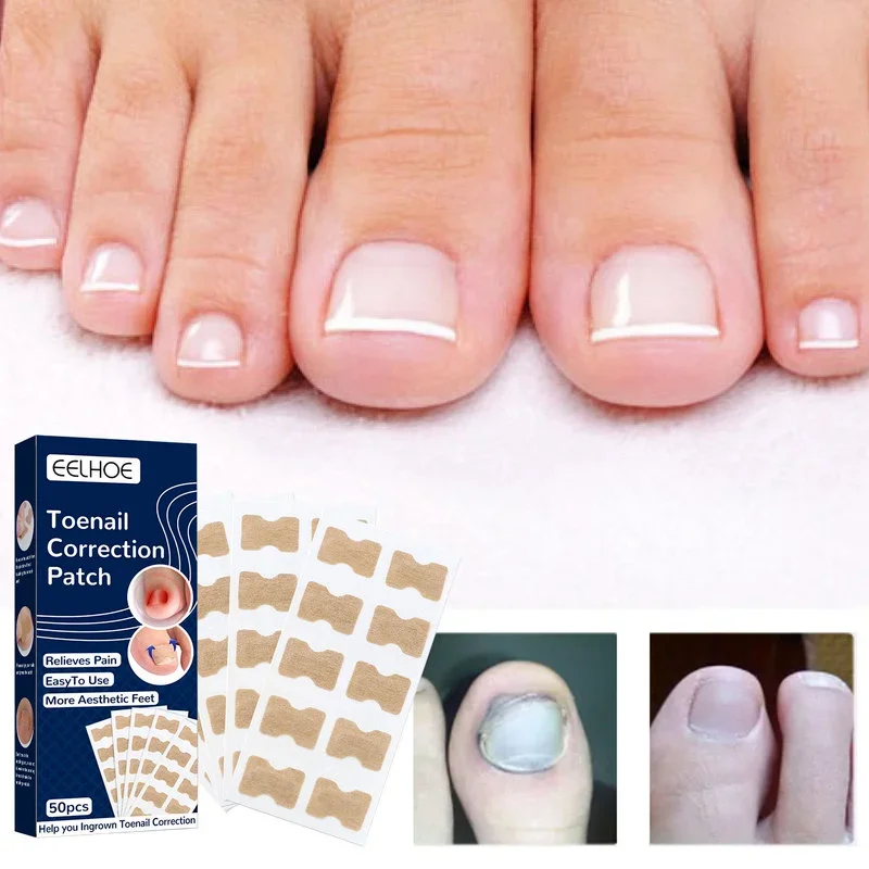 50PCS Ingrown Toenail Correction Tool, Waterproof Nail Correction Stickers for Paronychia Treatment