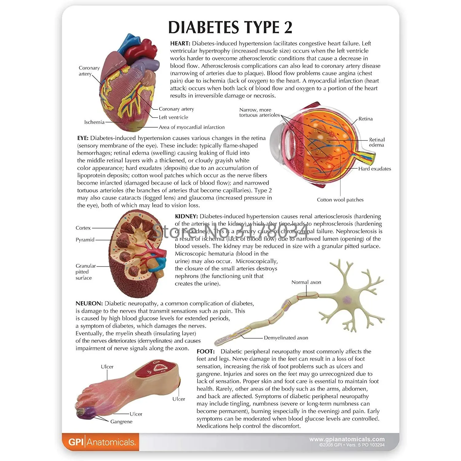 Type II Diabetes Model Set 5
