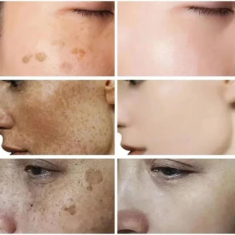 Dark spots remover Whitening serum Face freckle Melanin correcting Anti pigmentation Brighten essence cream Korean skin care