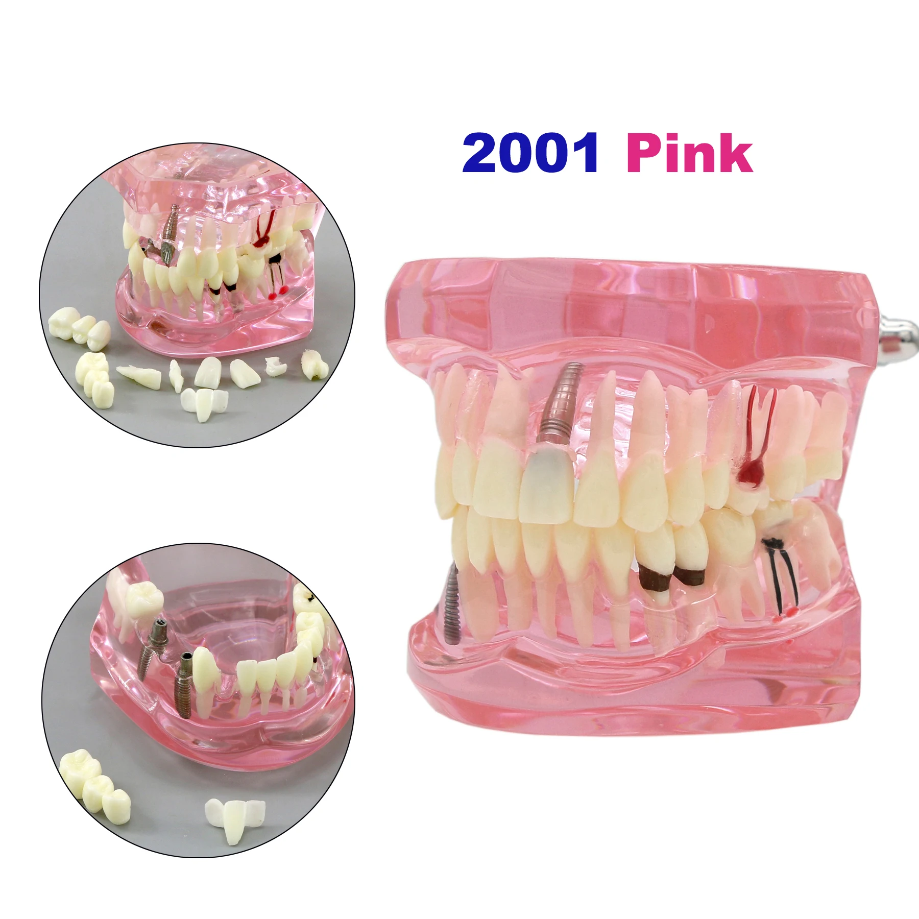 

Dental Implant Teeth Model Teeth Removable Neural Repair Demonstration for Dentist Practice Dentistry Disease Teaching Model