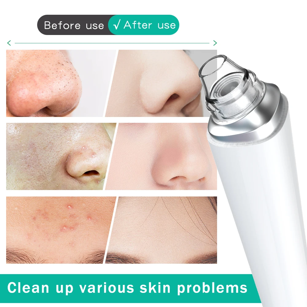 Blackhead Removal Device Image 2