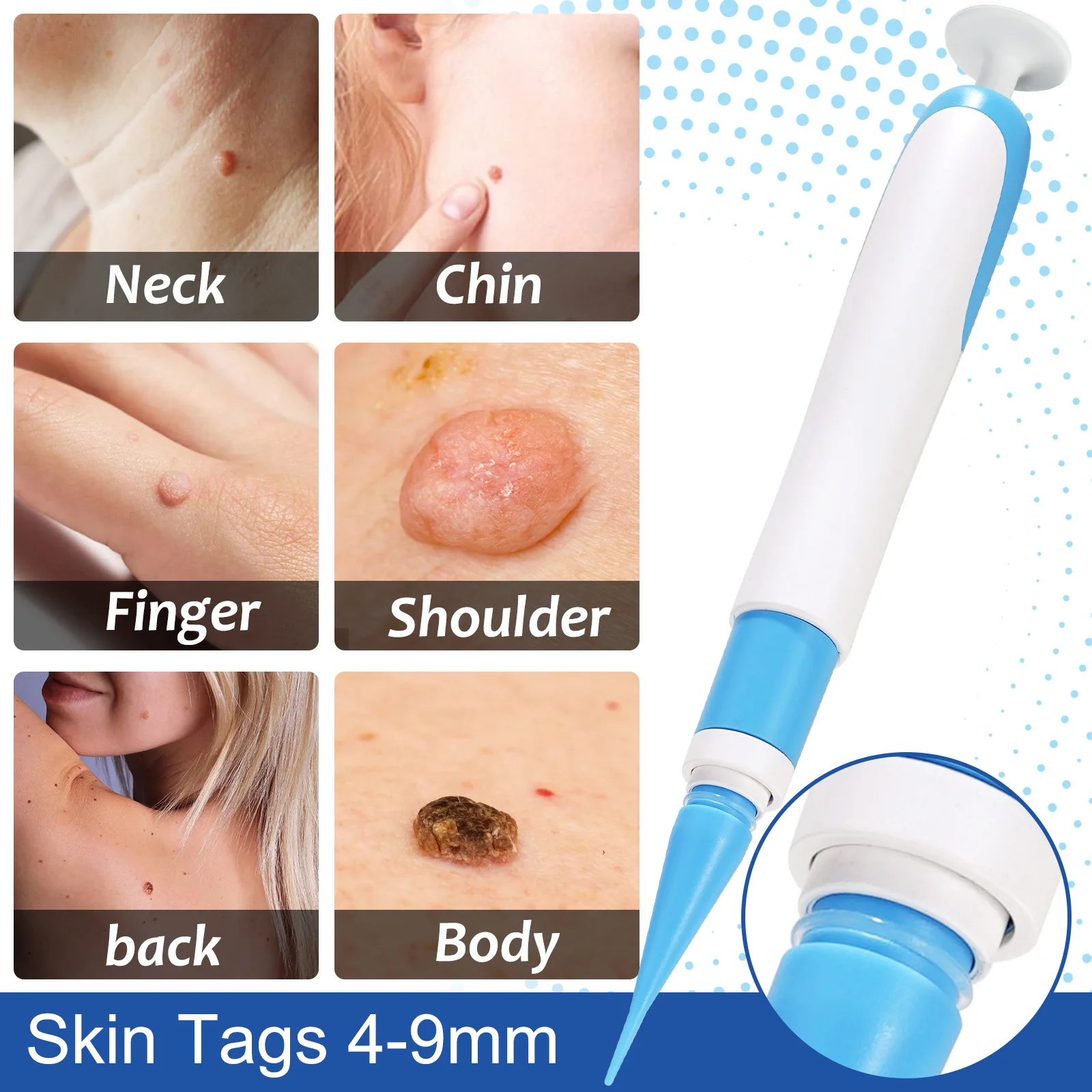 Painless Mole Removal Tool Kit for Facial Skin Care