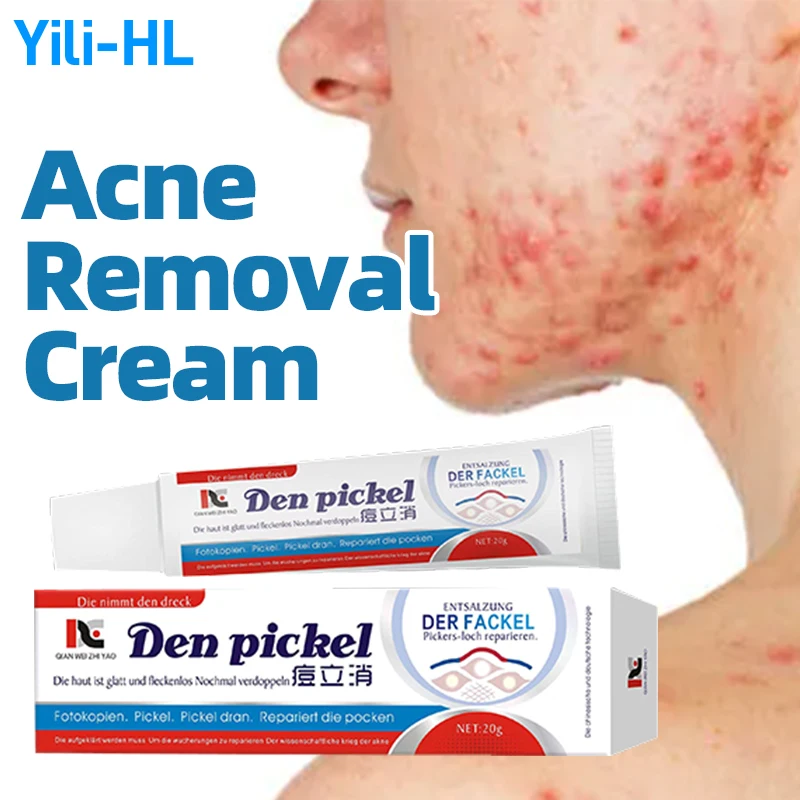 

Acne Removal Treatment Cream Pimple Anti Acne Marks Remover Ointment Blackhead Shrink Pores Face Care German Secret Recipe
