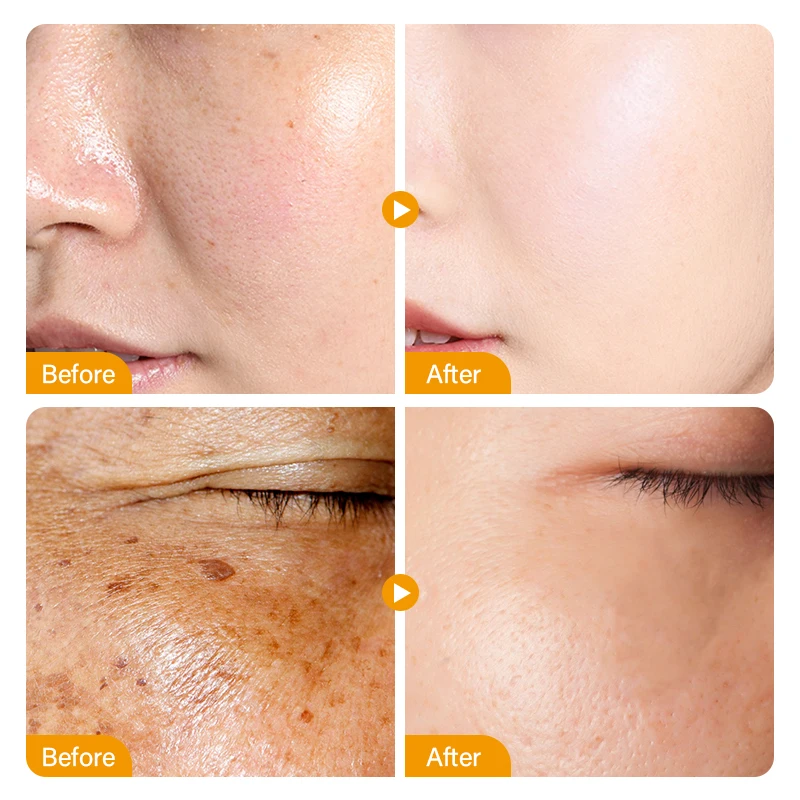 Nicotinamide Whitening Freckles Serum Face Dark Spot Remover Vitamin C Lightening Melanin Blemish Moisturizer Brighten Skin Care 4