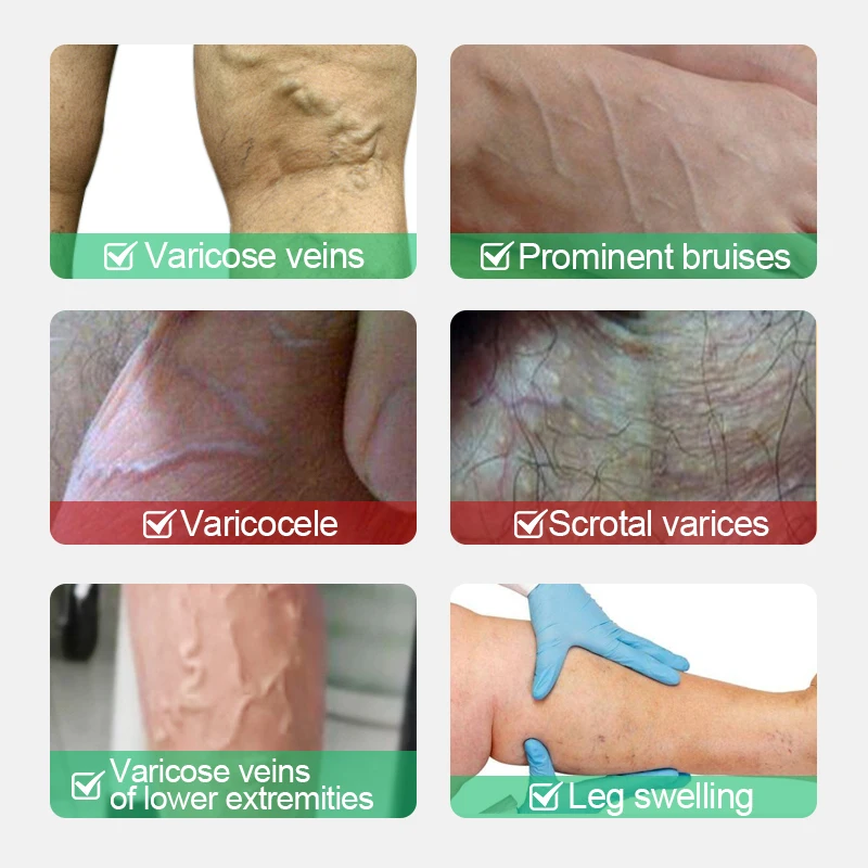 Men's Varicose Vein Ointment 1pcs Groin Pain Varicocele Cream Scrotum Swelling And Pain Improve Decreased Sexual Function G010 pain relief cream skin care ointment