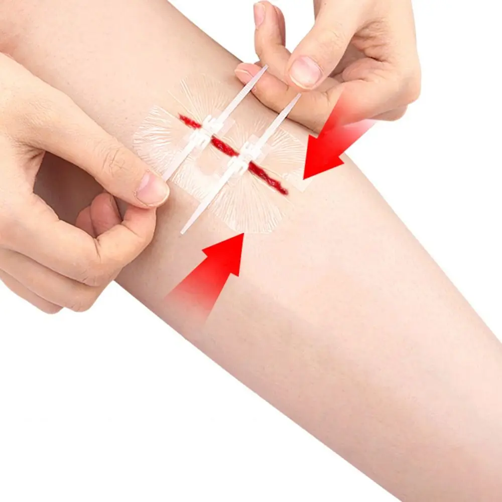 Adhesive Wound Care Zip Sutures Bandaids First Aid Without Stitches Emergency Wound Closures Emergency Zipper Laceration Repair