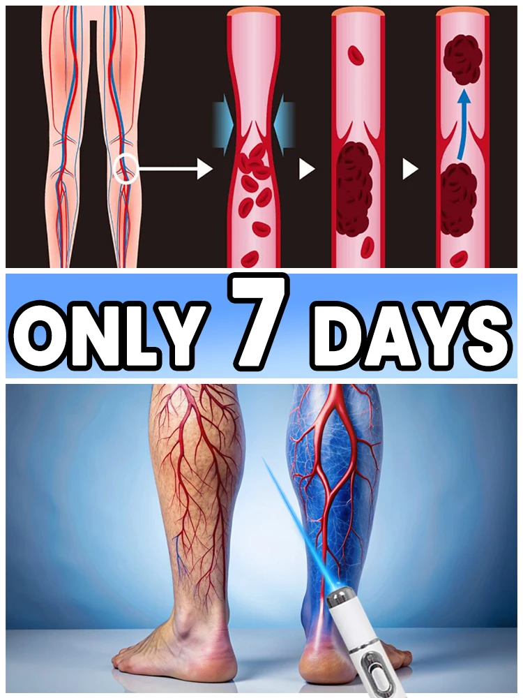 Mini Varicose Vein Blue Light Device Painless Leg Care