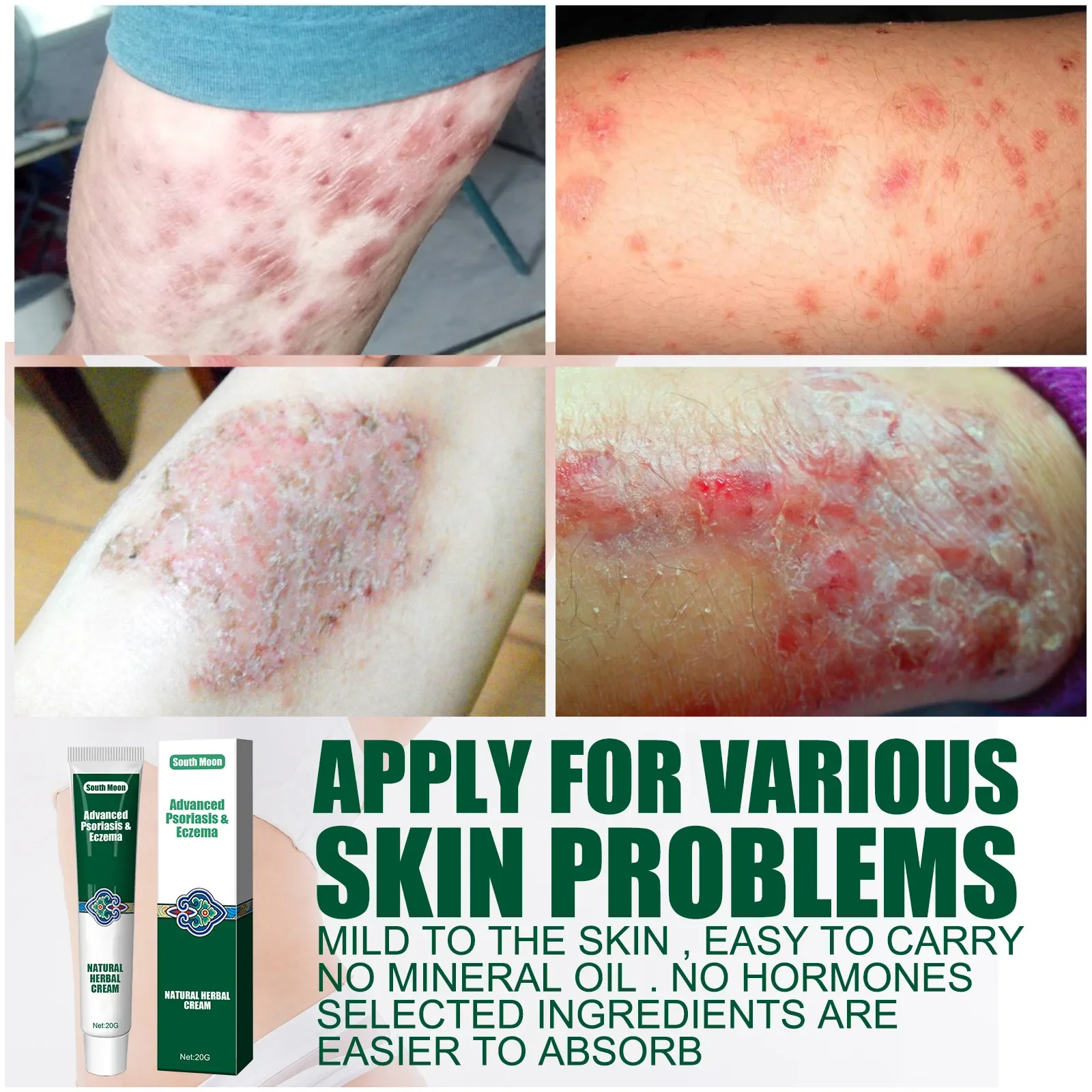 South Moon Psoriasis Ointment Eczema Herbal Cream Treatment Urticaria Desquamation Antibacterial Anti-Itching Health Skin Care