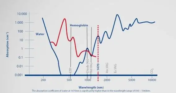 Рисунок 4 - Новый 1940 нм технологический хирургический