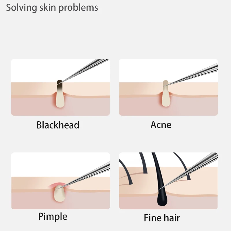 Acne Blackhead Removal Needles Stainless Steel Black Spot Blemish Pimple Removal Needle Deep Cleansing Tool Face Skin Care Kit 5