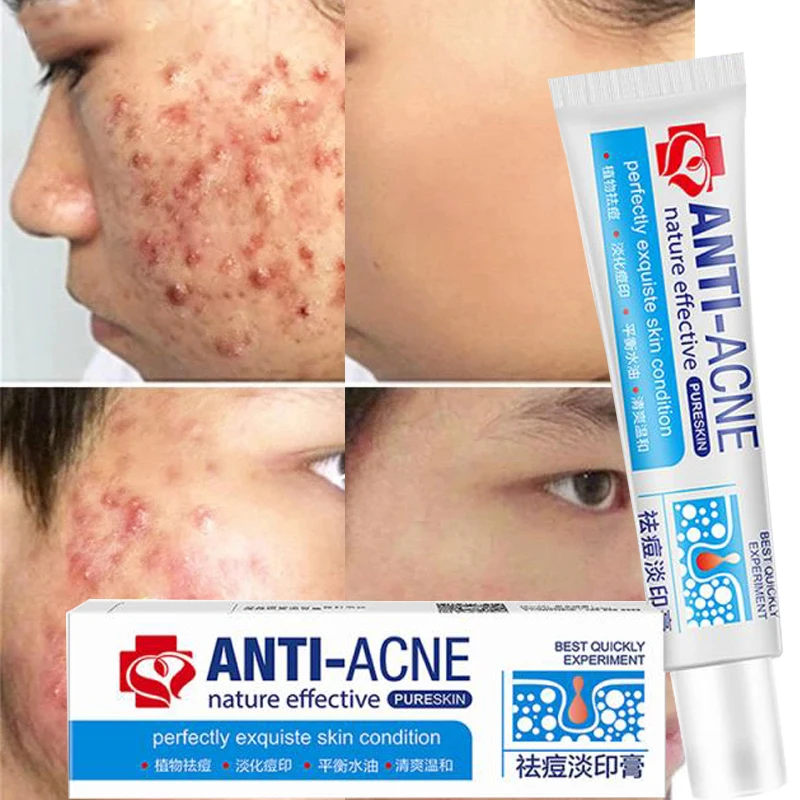 Chinese Effective Acne Cream Remove Pimples Dark Spots Acne Scars Cream Shrink Pores Deep Oil