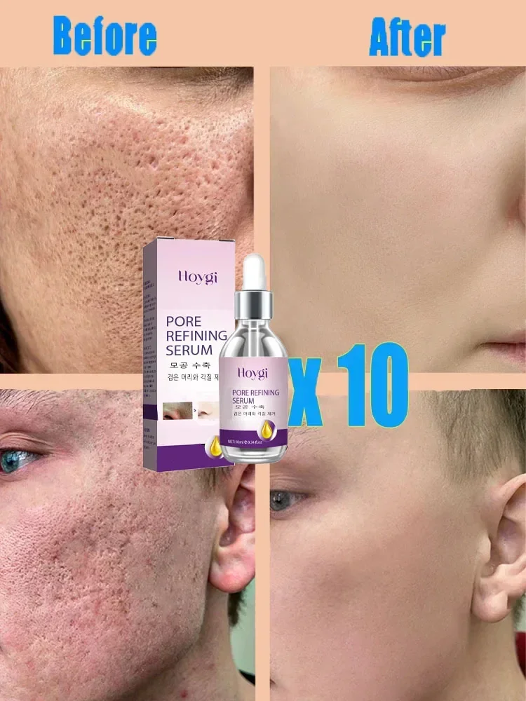 Textura de la piel refinamiento de los poros y regeneraci&oacute;n esencia facial sin acn&eacute;