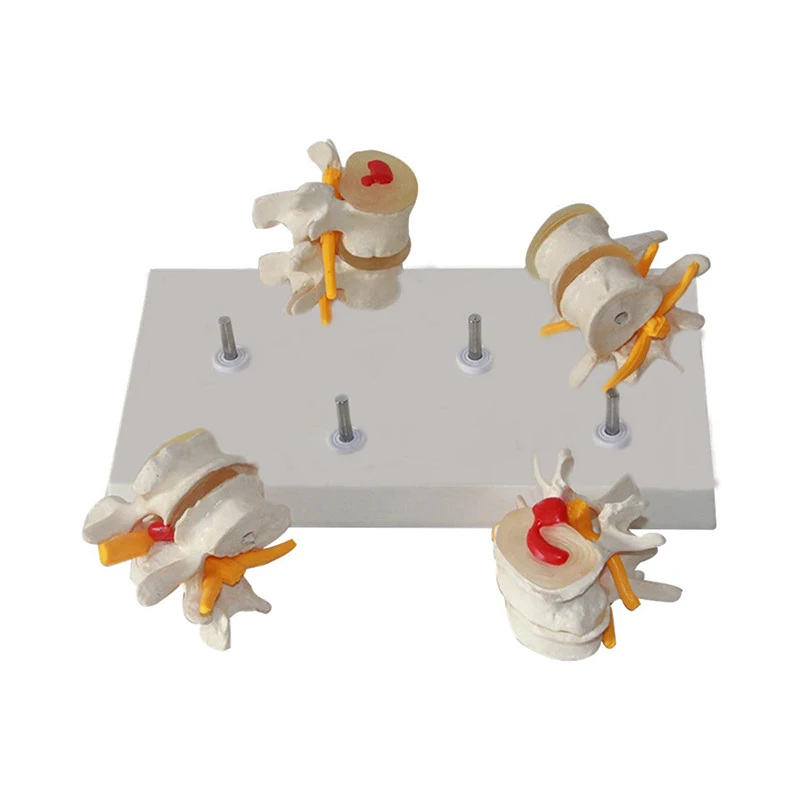 Anatomical Models 4-stage Pathological Human Lumbar Spine Anatomy Model Medical Science Teaching Resources