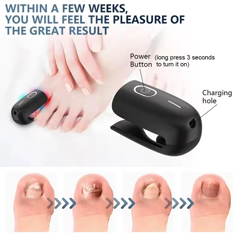 KTS Nail Fungus Laser Device Toenail Laser Therapy Machine Anti Fungal Equipment For Onychomycosis 910nm 407nm USB Charge