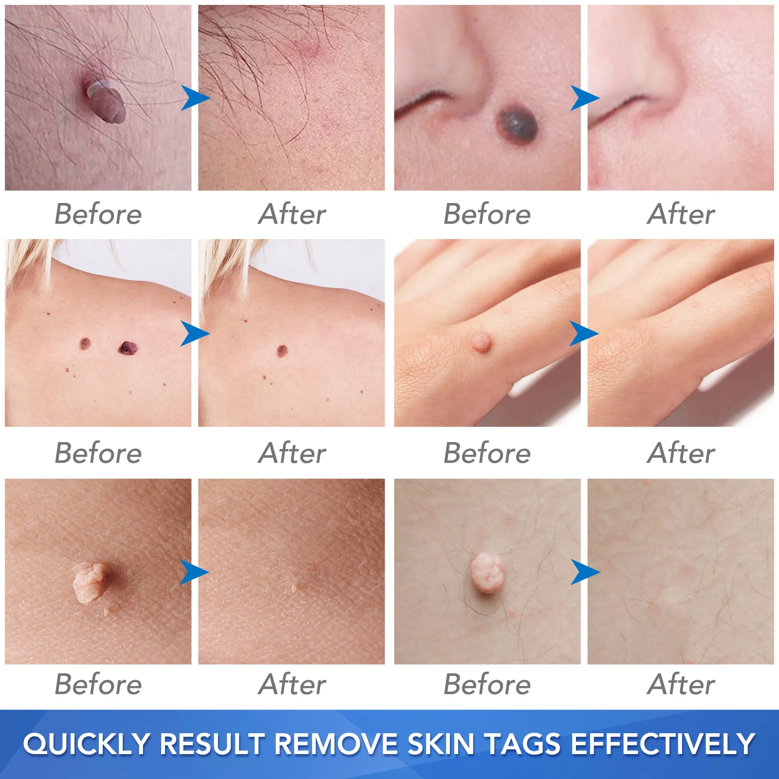 Painless Wart Removal Tool Kit for Skin Care