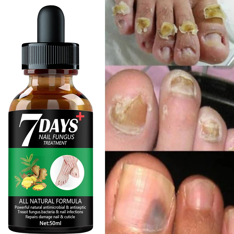 

Nail Fungus Treatment Essence Care Hand and Foot Care Removal and Repair Gel Anti-Infection Paronychia Onychomycosis (10ml-50ml)