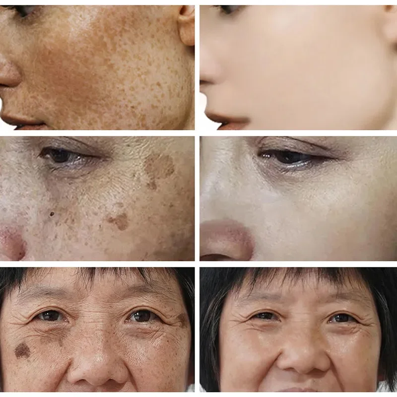 Glutathione Whitening Freckle Face Cream Remove Dark Spots Lighten Melasma Melanin Fade Acne Scars Anti-Aging_voghion.com