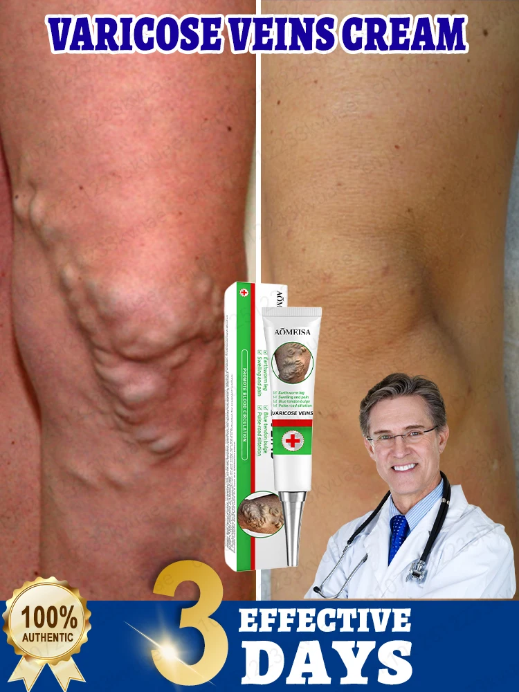Varicose vein ointment, repair varicose veins and vasculitis in 7 days