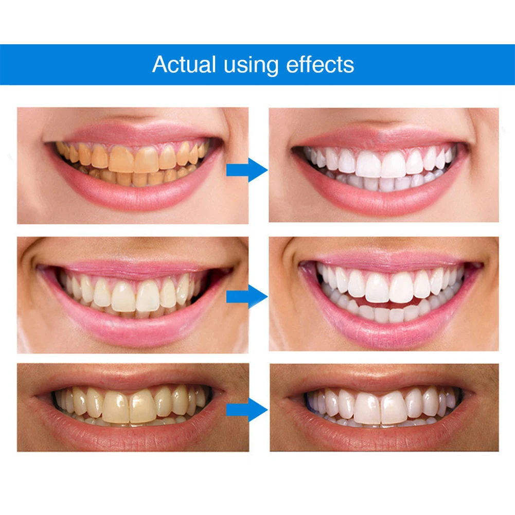 Teeth Whitening Pen 1-5PCS 4ml Effective Painless Gum Therapy Gel Teeth Whitening Essence Pen No Sensitivity Gel