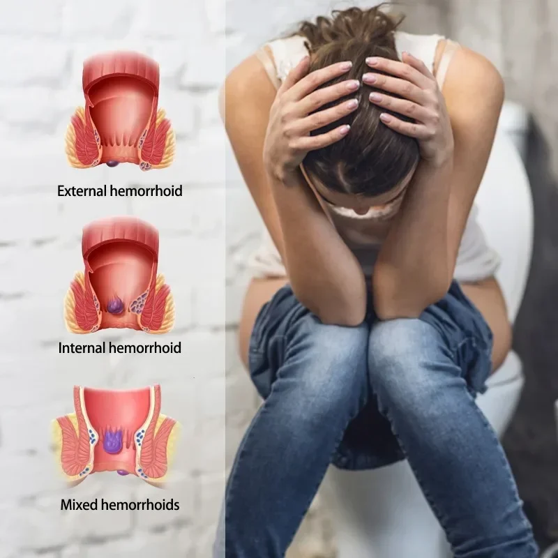 1Pcs Herbal Hemorrhoid Ointment Treat Butt Anal Fissure Pain Swell Repair Cream Internal External Hemorrhoids Eliminates Care