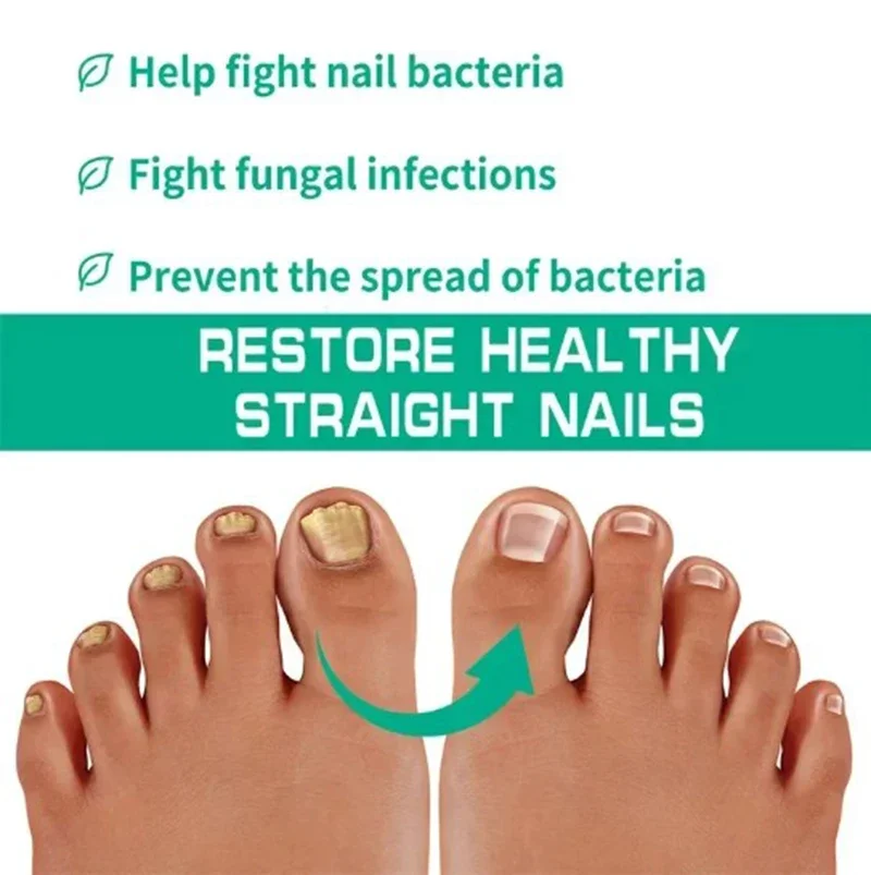 5Nail Fungals Renewal Nail Repair Liquid for Discolored Thickened Crumbled Nails Nail Fungals for Discolored Broken Cracked XXS5