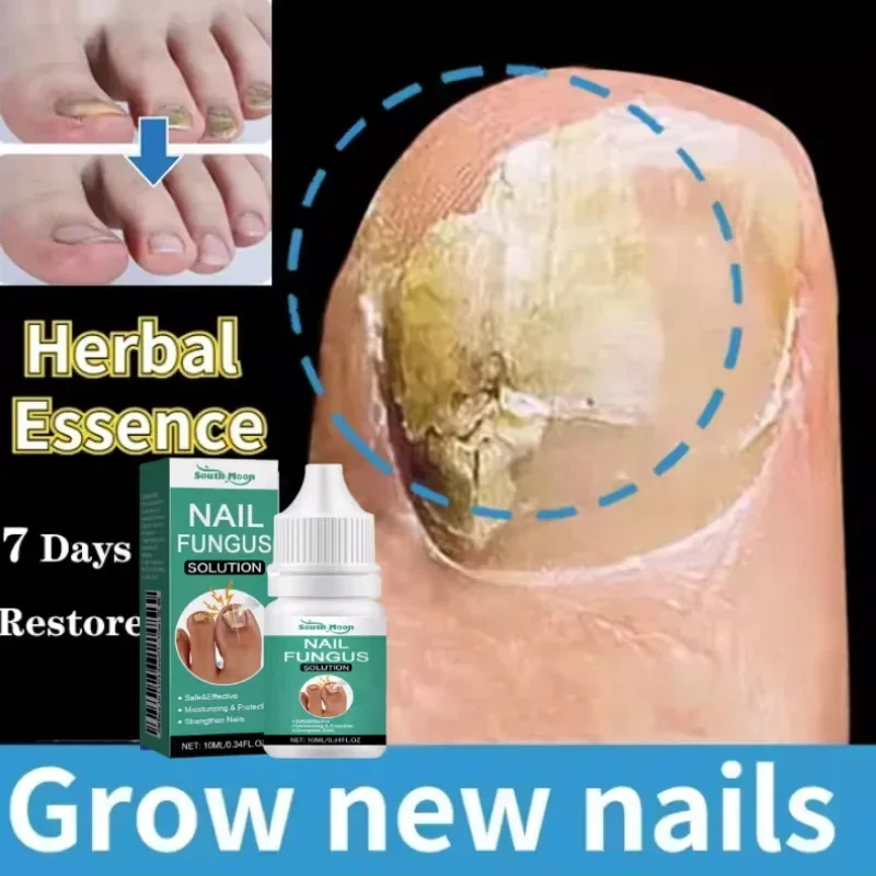 Fungal Nail Treatment Essence Oil Nail Fungus Laser Device Repair Toenail Fingernail Ginger Treatment Hand Foot Essence Liquid