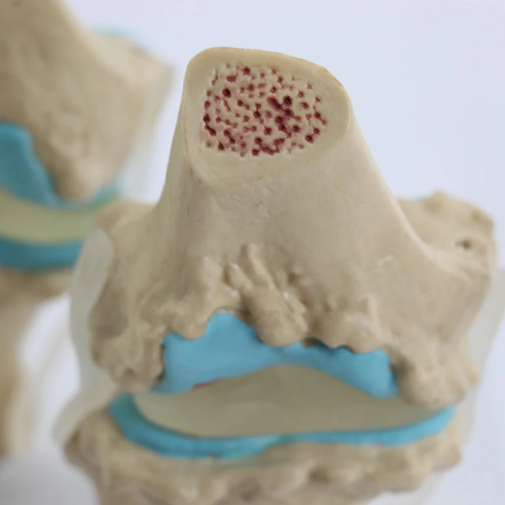 Four-Stage Human Pathological Knee Joint Anatomy Model Medical Science Teaching Resources Kit Models Dropshipping