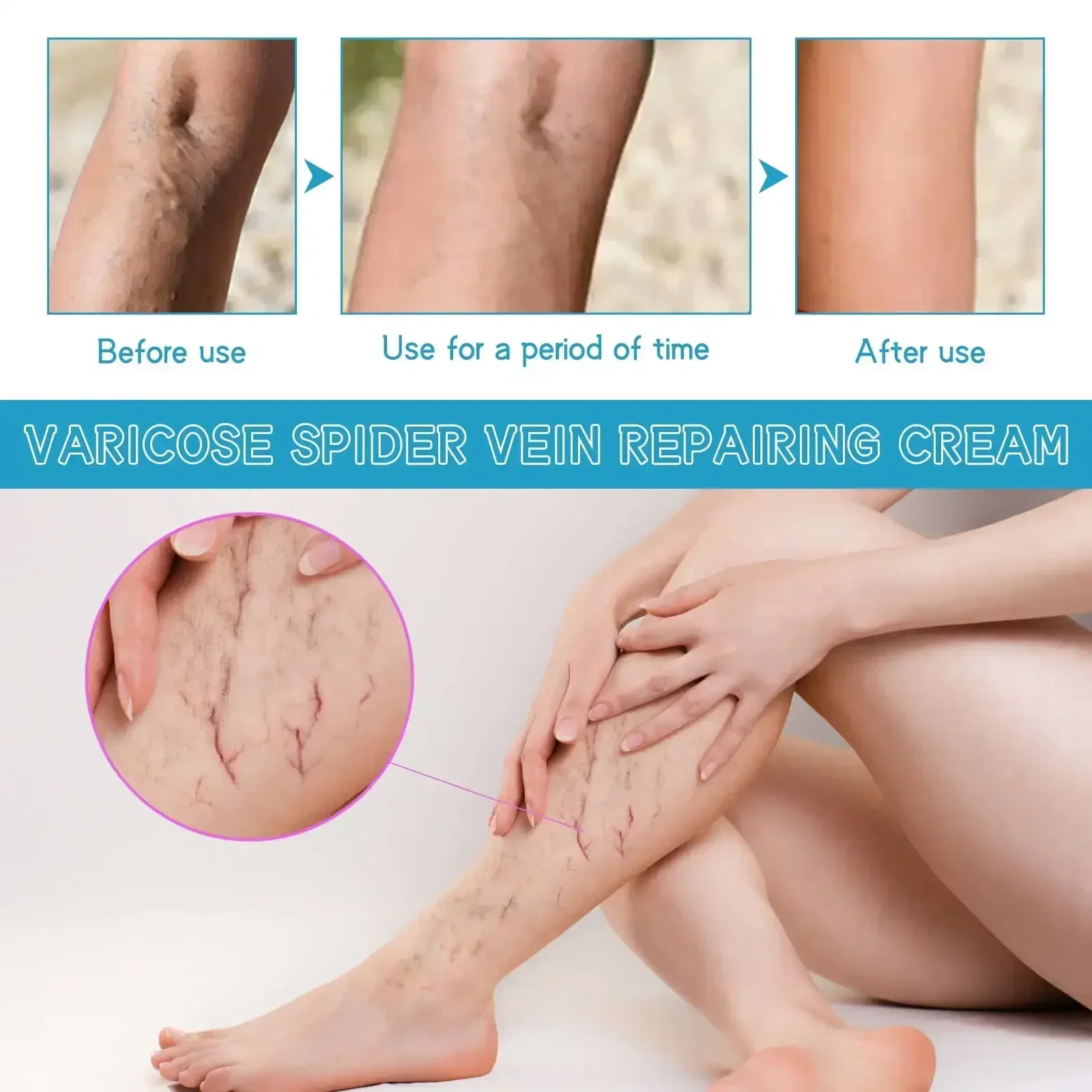 Varicose Vein Repair Cream Relieves Leg Bulge Pain Treatment Vasculitis Phlebitis