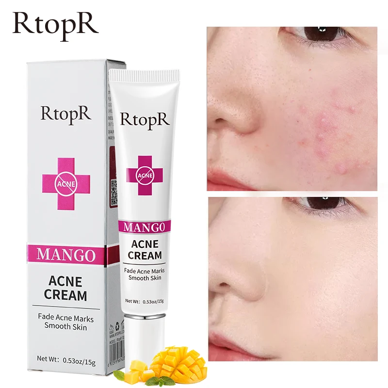 RtopR-Crema de Mango para el acné, elimina las marcas de acné en la cara, hidratante suave, limpia la piel, cuidado de la piel Facial, crema de día blanqueadora
