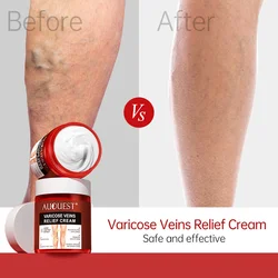 AUOUEST Varicose Veins Treatment Cream Phlebitis Vasculitis Spider Ointmnet Varicosity Removal Anti-Inflammatory Herbal Plaster