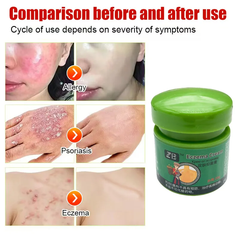 Skin Care Ointment 20g Psoriasis Cream Dermatitis Eczematoid Treatment Antibacterial Anti-Itch