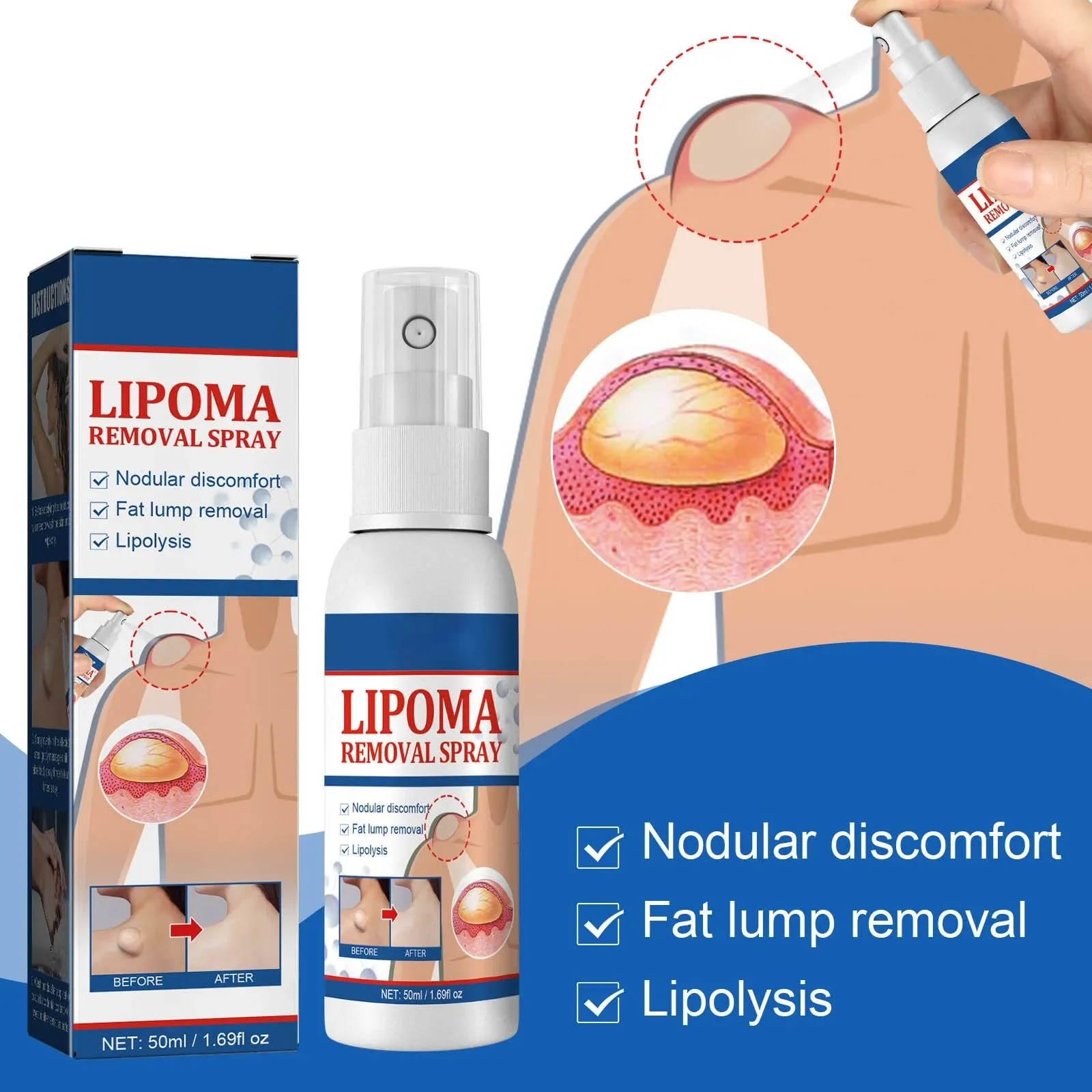 Fat knot Spray Relieves Body Lump Subcutaneous Nodule Dredging Spray Anti Tumor Mitigation Skin Swelling Pain Painless Treatment