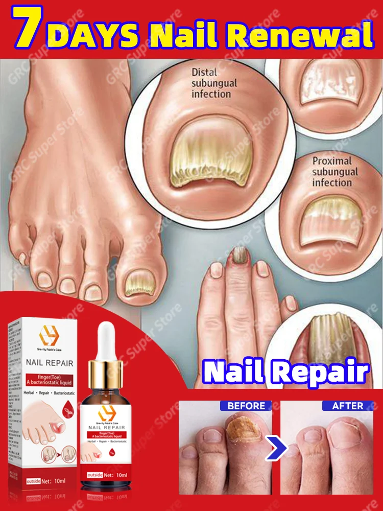 Serum repair of foot nails