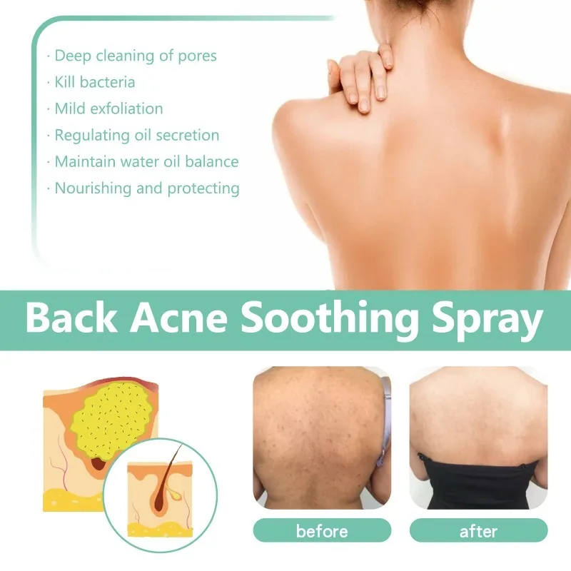 Whitening Cream Back Acne Repair Spray Acne Removal Essence Oil Oil Butt Shoulder Care Cream Control Back Whitening Moisturize Removal Spray