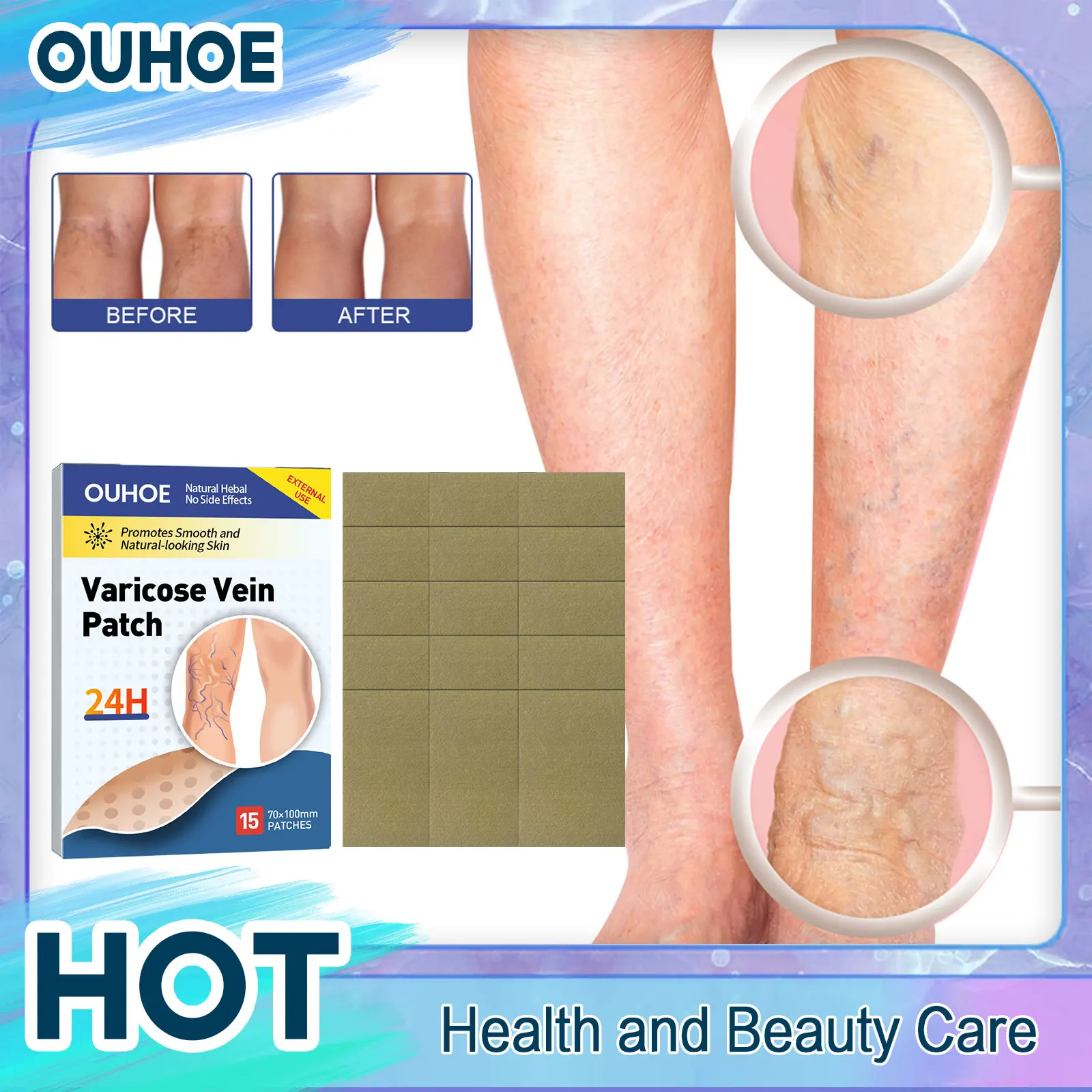 

Varicose Vein Patch Spider Legs Treatment Relieve Swelling Pain Vasculitis Phlebitis Improve Blood Foot Angiitis Removal Plaster