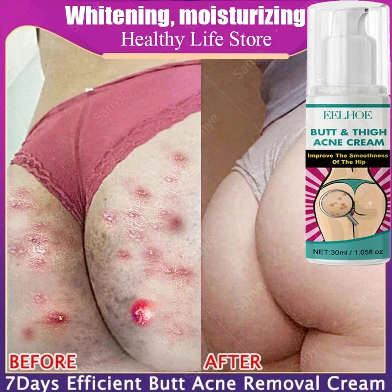 Butt Dull Brighten Serum Inner Thigh Brightening Cream Buttock Improve Pimples Smooth Skin Care Fade Melanin Lightening Lotion
