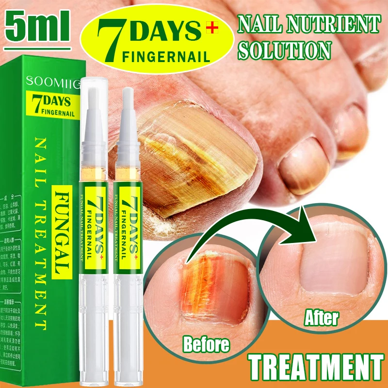 Nail Fungus Treatment Essence Pen, Hand And Foot Care,fungus Removal