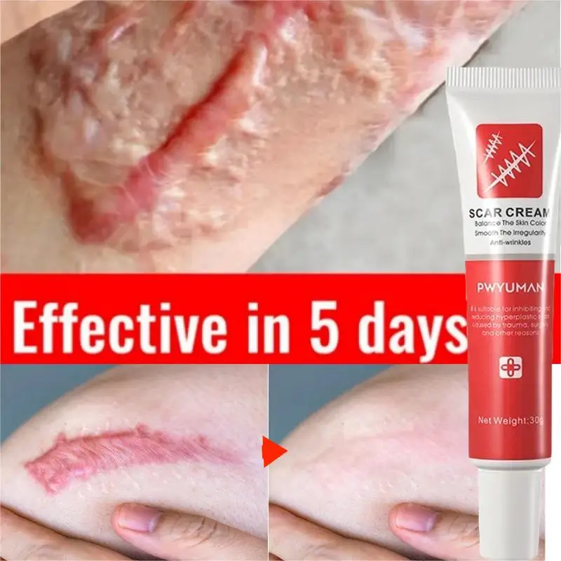 

Fast Scar Removal Cream Treatment Stretch Marks Burn Surgical Scar Ointment Repair Gel Fade Acne Spot Whitening Smooth Skin Care