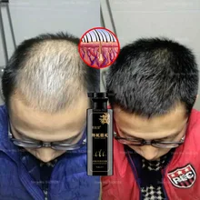 Anti-dandruff Anti-itch Oil-control, Fluffy Men's and Women's Shampoo, Hair Growth and Anti-dropping Shampoo Hair Loss Products