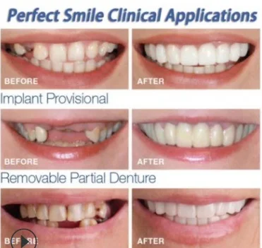 Simulation Braces Mamum Instant Smile Comfort Fit Flex Cosmetic Teeth Denture Teeth Top Cosmetic Veneer 3 set = 6 pieces