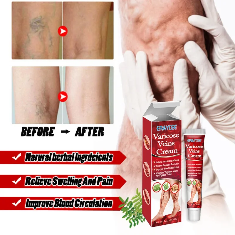 

Ointment varicose veins Effective vein relief cream Eliminate Spider Leg relieve vasculitis phlebitis spider pain treatment care