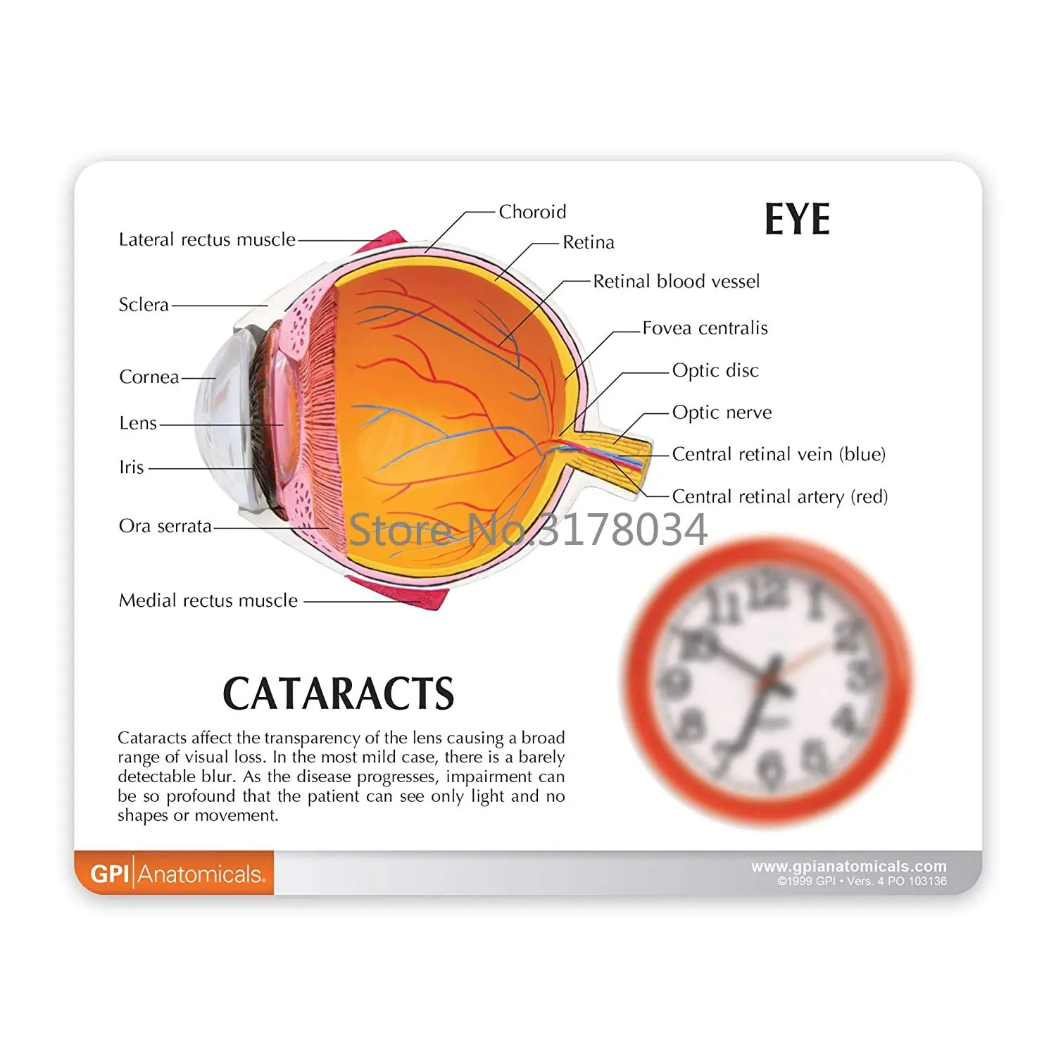 Human Cataract Eye Anatomical Model – Anatomy Replica of Normal Eye Educational Medical Tool for Doctor’s Office 2