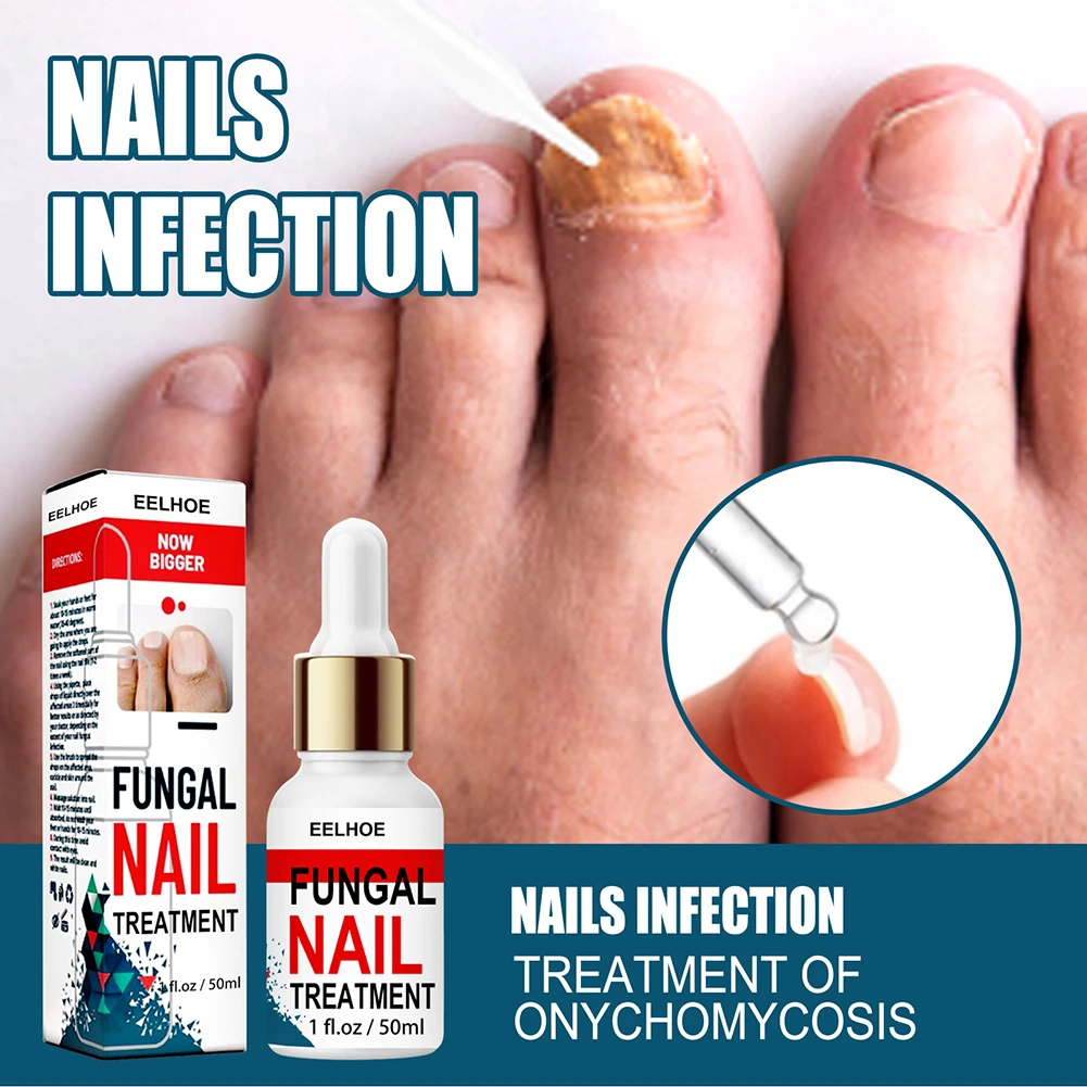 Nail Fungus Treatment Cream Onychomycosis Paronychia Anti Fungal Herbal ...