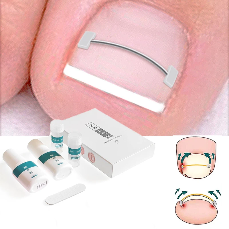 

Toenail Corrector Tools Pedicure Recover Embed Toe Nail Treatment Professional Ingrown Toenail Correction Foot CareTool Ingrown