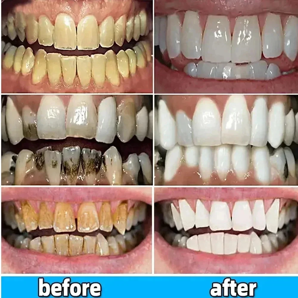 Dental Calculus Remover Teeth Whitening Toothpaste Oral Hygiene Cleaning Remove Plaque Stains Prevent Periodontitis Fresh Breath