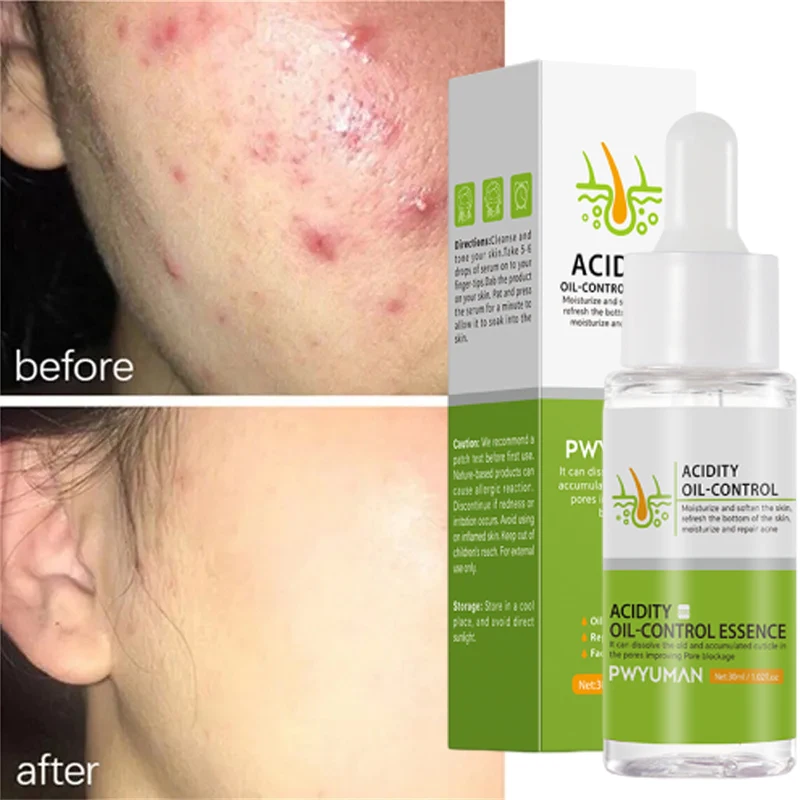 

Fruit Acid Acne Treatment Serum Eliminate Acne Marks Shrink Pores Oil Control Smooth Moisturizing Essence Korean Face Skin Care