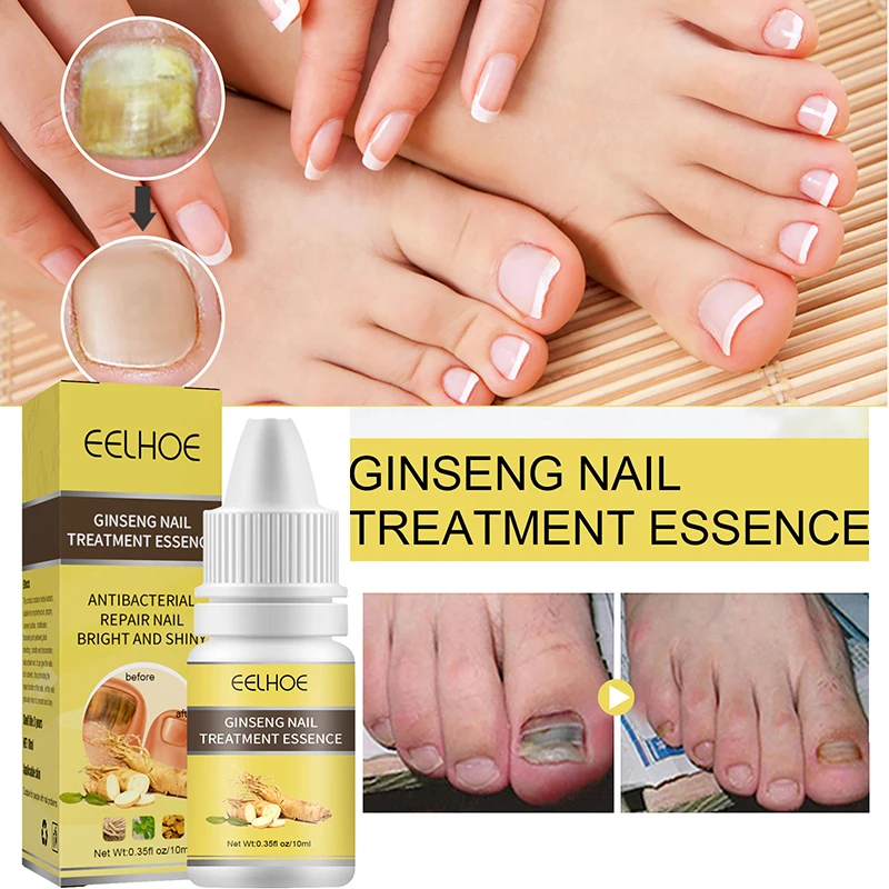 NailFungusRemovalCreamOnychomycosisFungalNailTreatment