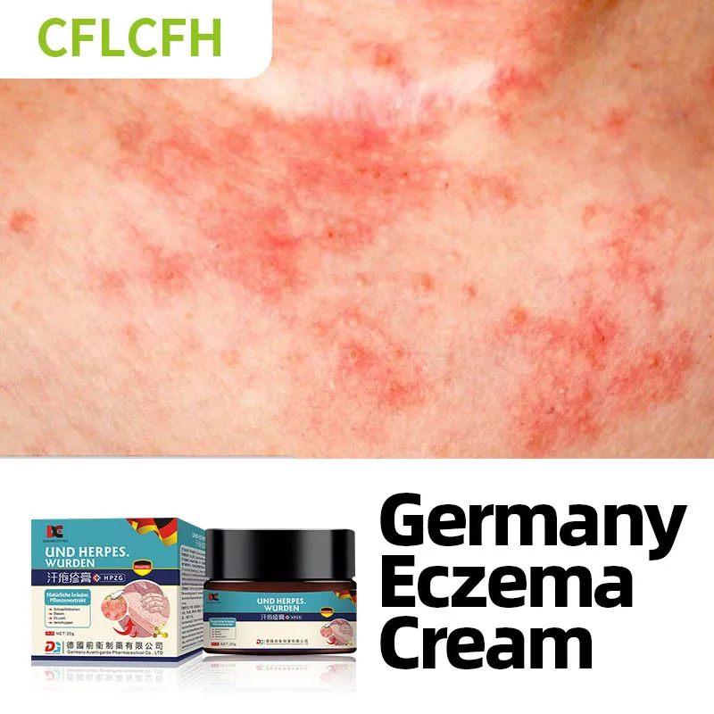 

Eczema Psoriasis Treatment Cream Dermatitis Eczematoid Fungus Antibacterial Anti-itch Pompholyx Ointment Germany Herbal Medicine