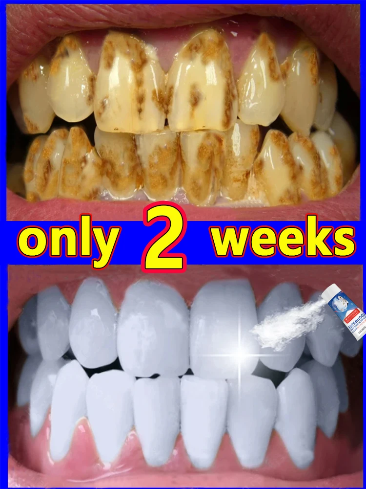 

Whitening and cleaning toothpaste, remove tartar, yellow teeth, bad breath and periodontitis in 7 days